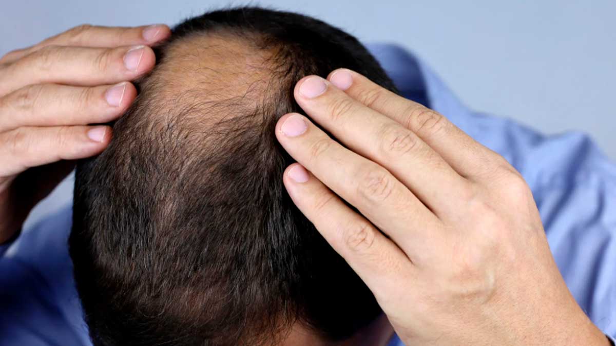 Hombre con caída del pelo mostrando calvicie, relacionada con la proteína GRK2